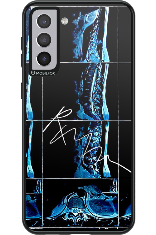 RMN Scolioza 2.0 - Samsung Galaxy S21+