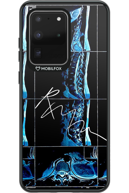 RMN Scolioza 2.0 - Samsung Galaxy S20 Ultra 5G