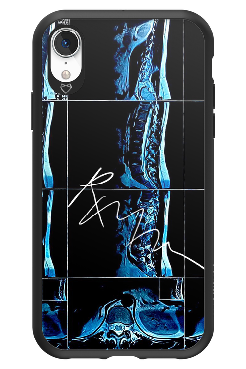 RMN Scolioza 2.0 - Apple iPhone XR