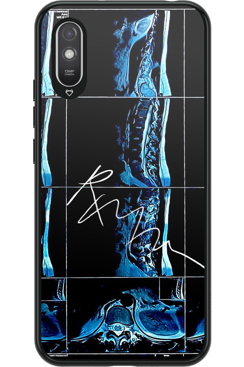 RMN Scolioza 2.0 - Xiaomi Redmi 9A